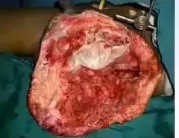 创面感染肿胀吃什么消炎药,创面感染原因