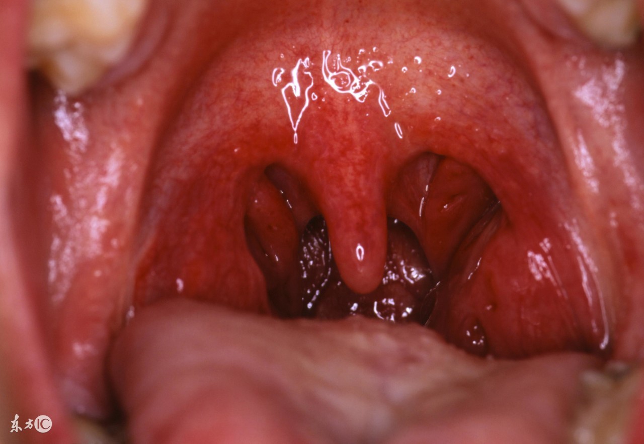 慢性咽炎为何顽固,慢性咽炎为什么难治断根