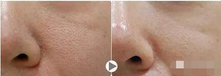 毛孔粗大收缩毛孔最有效的土方法,毛孔粗大怎么办教你快速收缩毛孔