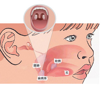 儿童扁桃体发炎引起咳嗽吃什么药,感冒扁桃体发炎咽喉肿痛吃什么药