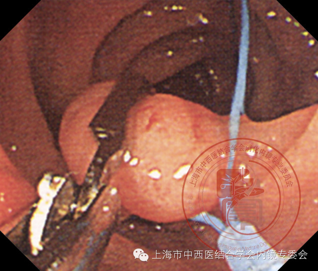 内镜套扎是什么,内镜套扎器械