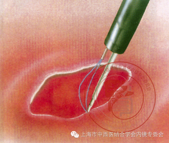 内镜套扎是什么,内镜套扎器械