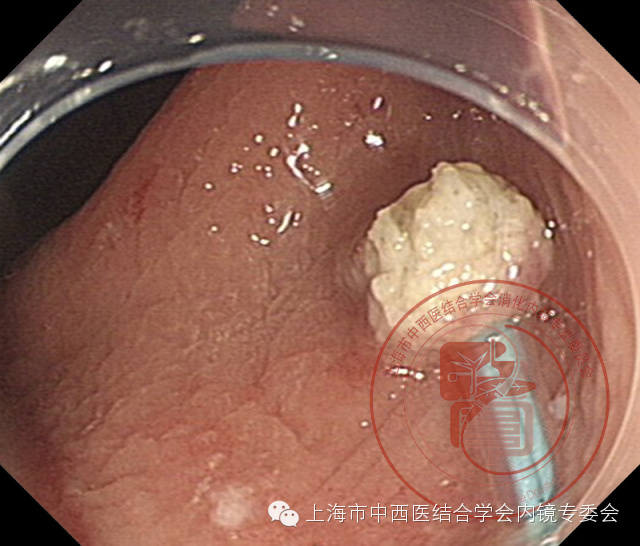 内镜套扎是什么,内镜套扎器械