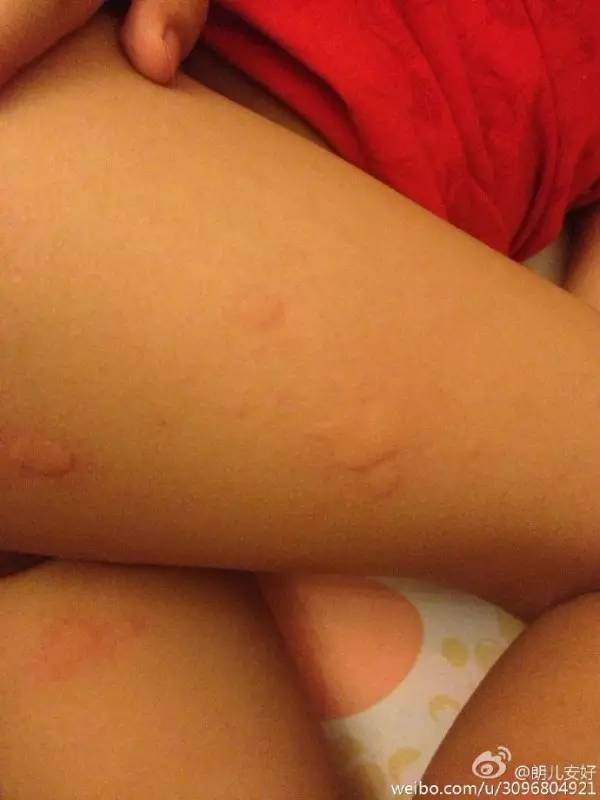 荨麻疹的症状和治疗崔玉涛,得过荨麻疹的能打麻疹疫苗吗