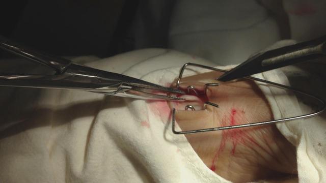 拇指弹响治疗方法,拇指腱鞘炎弹响最快的恢复方法