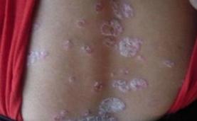 情绪不好出现皮肤病,情绪不稳定得皮肤病