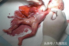 女性做人流没流干净，这对女性健康来说祸患无穷！