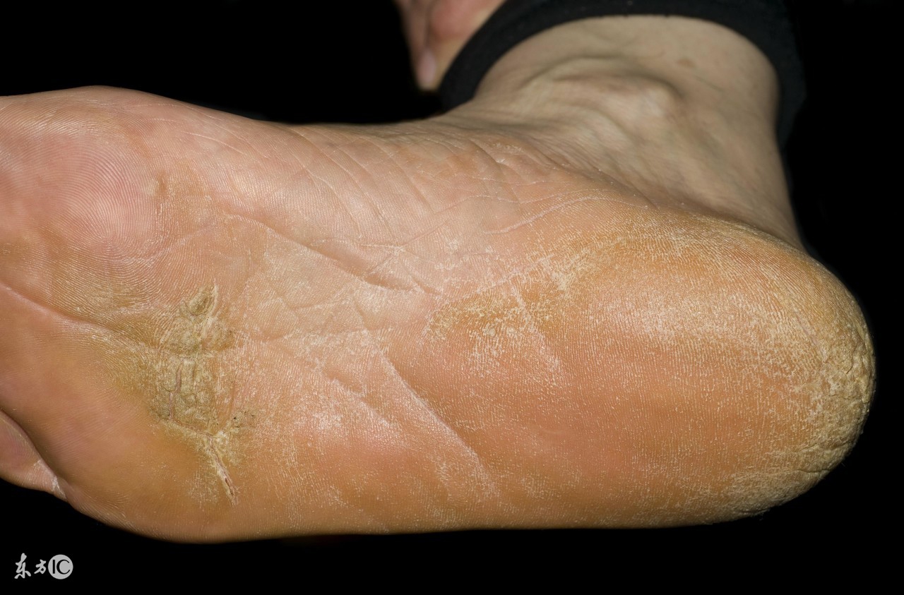 下雨天怎么防止脚水肿,香港脚要如何预防