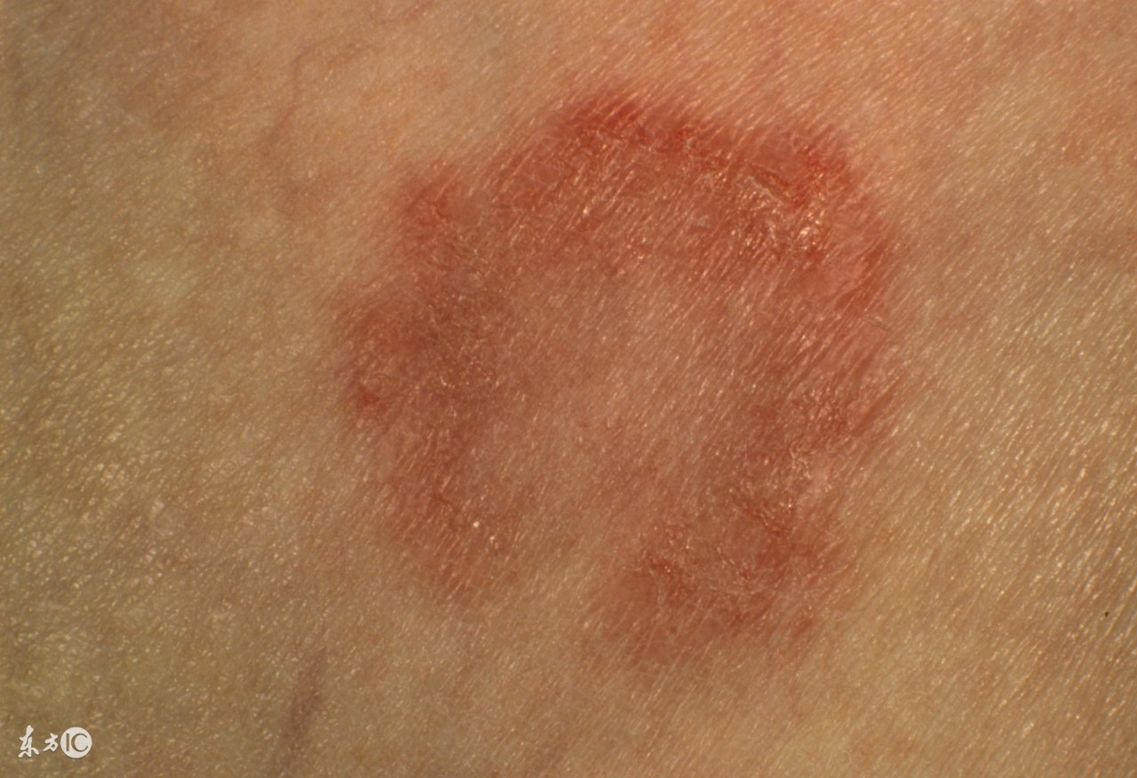 下雨天怎么防止脚水肿,香港脚要如何预防