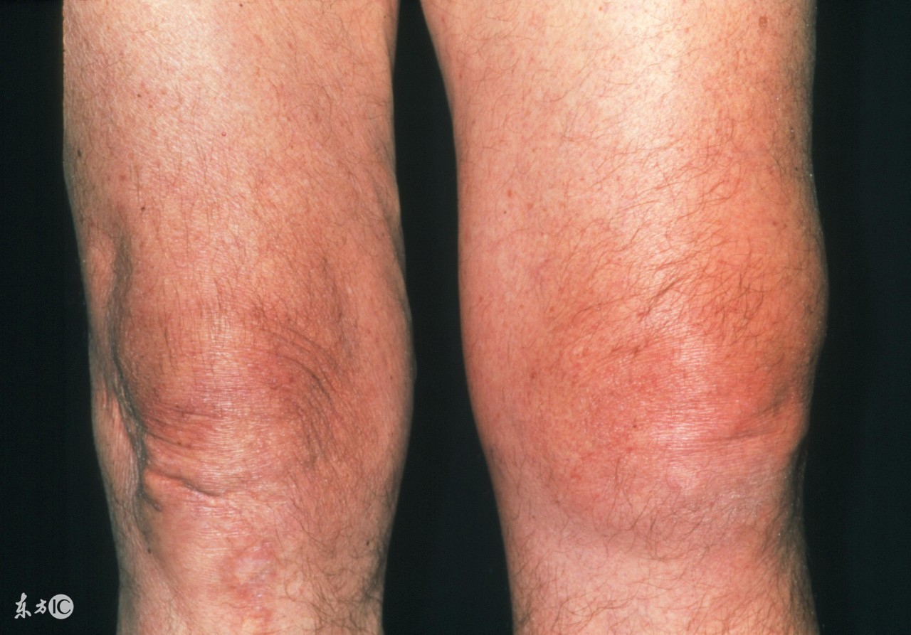 走路打软腿是什么原因造成的,走路走多了容易得什么病