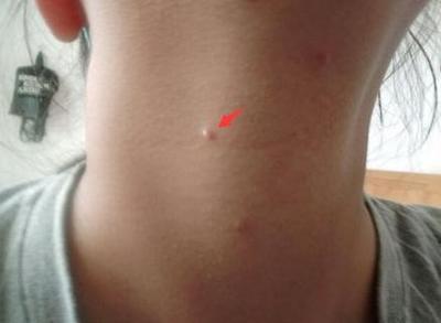 颈部长肉粒是什么病,颈部长好多小肉痣怎么治疗