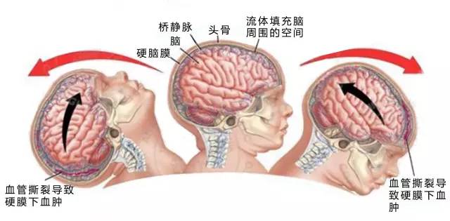 婴儿被摇晃致死,婴儿被摇晃后果