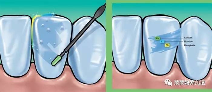儿童涂氟前需要做口腔内窥镜吗,小孩牙齿涂氟好还是做窝沟封闭好