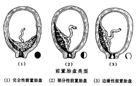 孕晚期前置胎盘一定会大出血吗,前置胎盘29周见红是什么情况