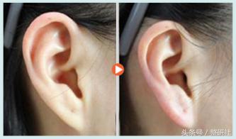 完美耳部成形术功能外观与福气集一身