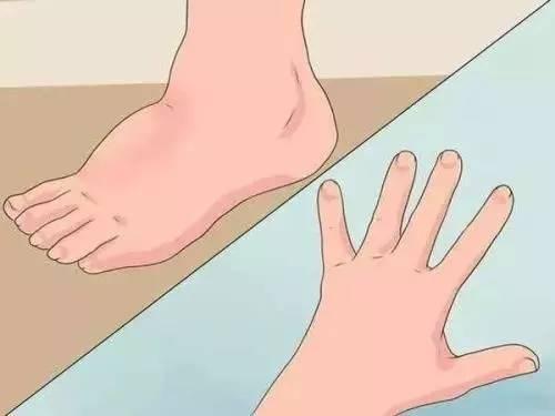 肾炎水肿好治疗吗？有没有偏方？