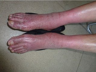 湿疹是怎么得的好了又复发,治湿疹最有效的植物