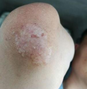 湿疹是怎么得的好了又复发,治湿疹最有效的植物