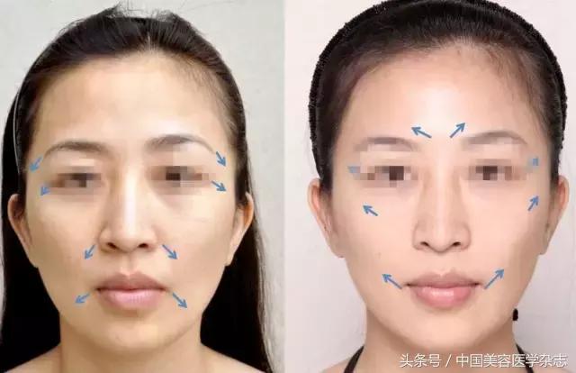 线雕面部提升女的,少女线雕术