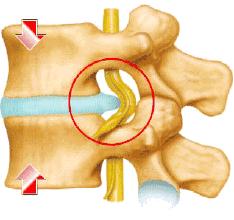 腰椎间盘突出或膨出可以练瑜伽不,腰间盘突出练瑜伽怎么样