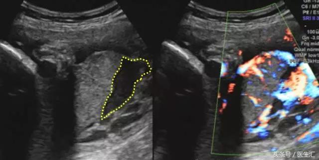 胎盘早剥诊断ppt,胎盘早剥的诊断与护理试题