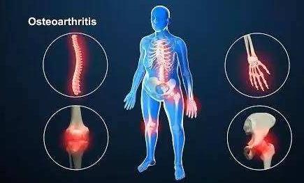 骨关节炎：排在首位的致残性疾病！（附靠谱的三甲医院和医生名单）