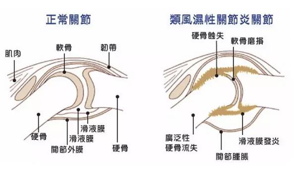 骨关节炎最新诊疗指南,骨关节前十医院