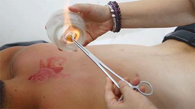 拔罐的好处和拔罐方法注意事项,拔罐慎重