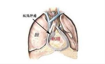 易恶变的良性瘤,阴超判断肿瘤良性恶性准确率