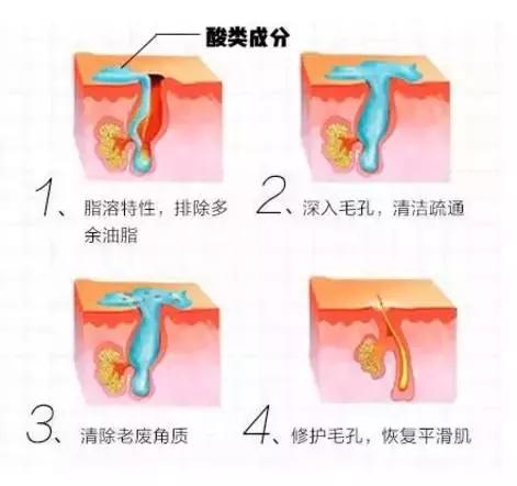 痘痘闭口摸起来还有点疼痛,痘痘闭口反反复复怎么办