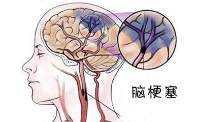 脑梗塞、脑血栓、脑出血不同时期怎么治疗