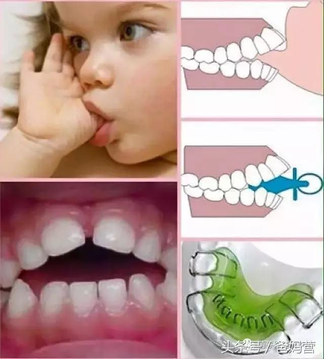 如何戒掉小孩子吃手,儿童戒掉吃手指瘾的方法