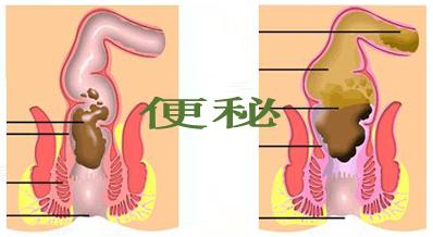 老人每天一次腹泻,老人一天腹泻十几次服什么药