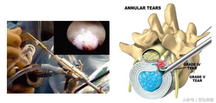 腰椎间盘突出症完全康复不是梦！早诊断、早治疗！