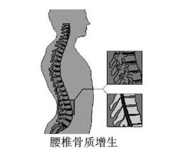 骨刺和骨质增生的区别图,骨刺其实不是病别再被忽悠了
