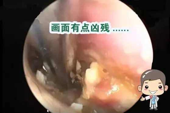不是奇谈|小伙儿耳内取出蚕豆大小胆脂瘤,自称耳痛10年未曾就医