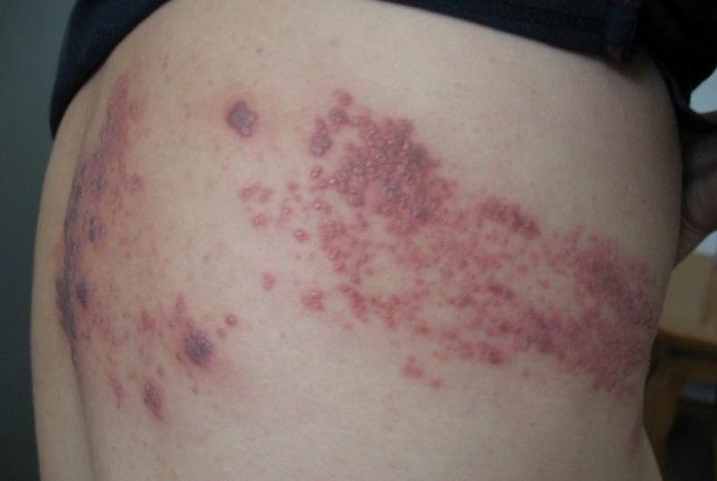 带状疱疹后遗神经痛针灸,带状疱疹后遗神经痛贴膏