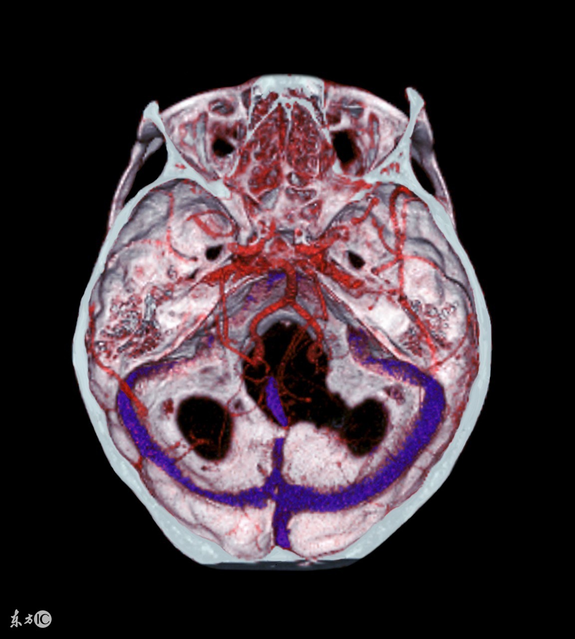 颅内静脉窦血栓形成怎么治疗,颅内静脉窦血栓怎么治疗