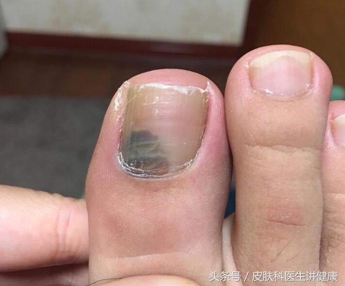 超过30岁脸上的斑点越来越多,突然长出来的色素痣会自行消退吗