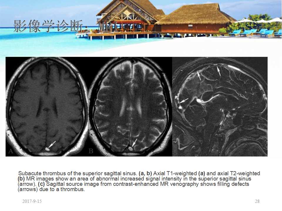 颅内静脉窦血栓形成怎么治疗,颅内静脉窦血栓怎么治疗