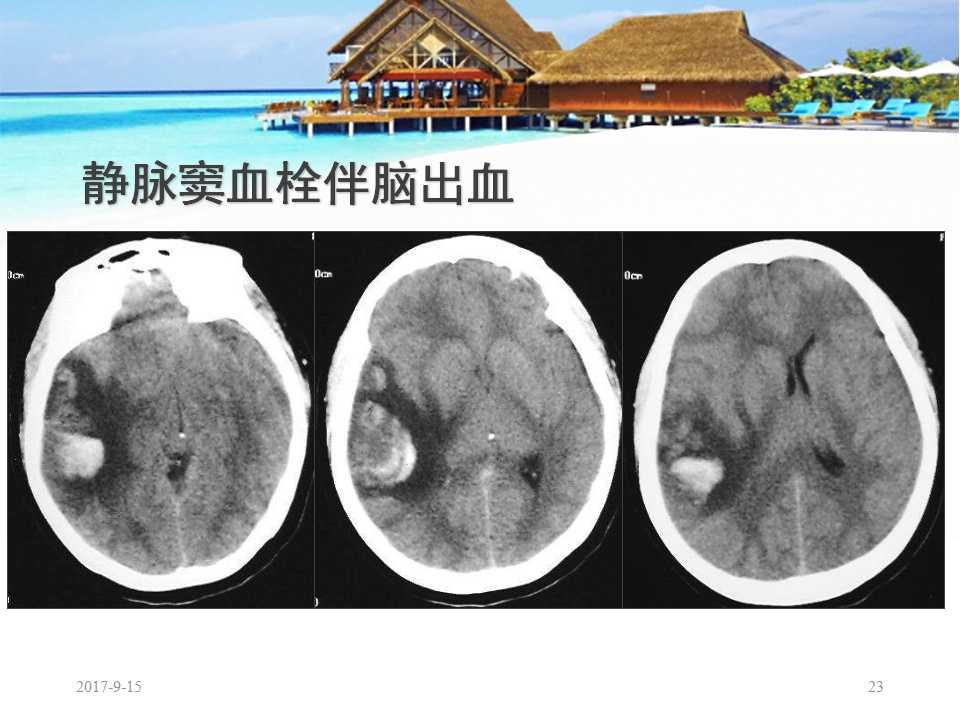 颅内静脉窦血栓形成怎么治疗,颅内静脉窦血栓形成最佳治疗方法