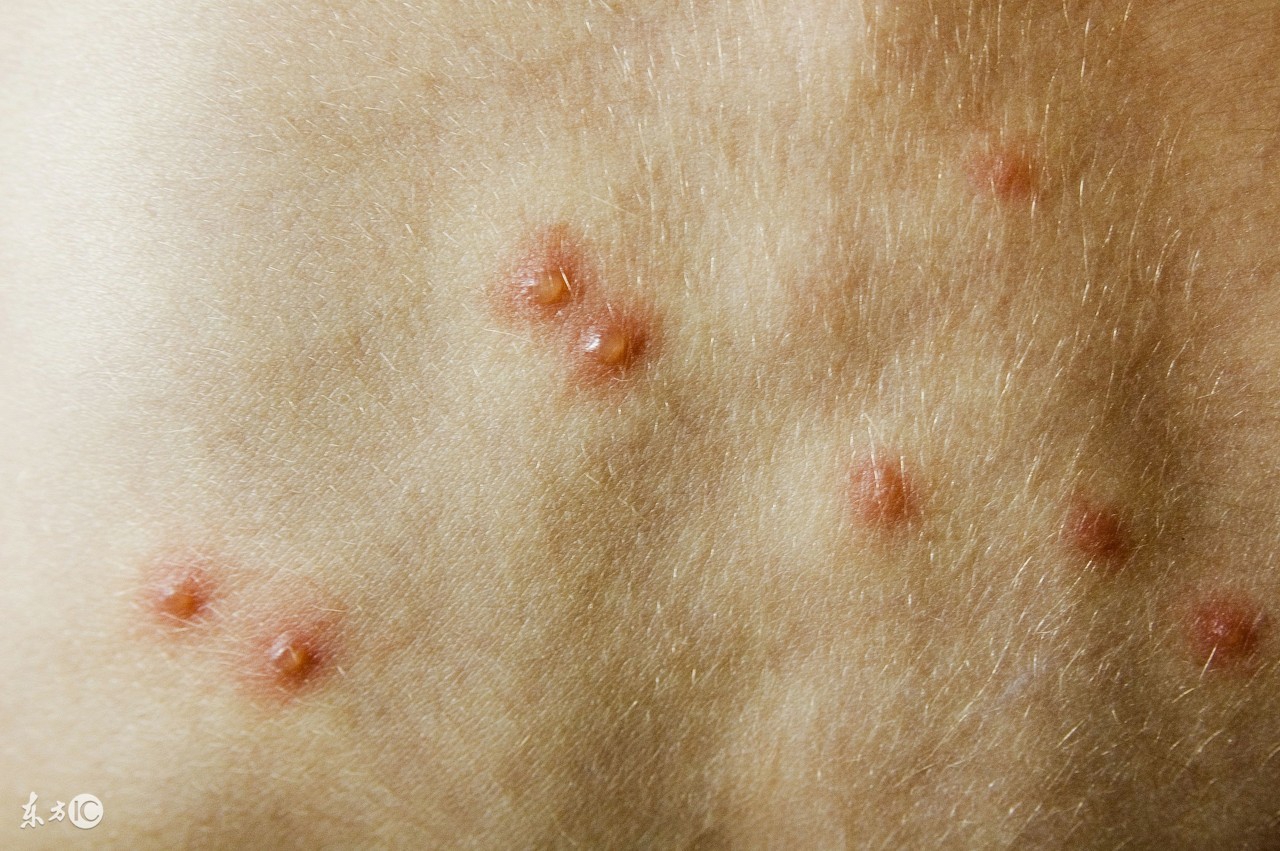 妈妈得了水痘宝宝怎么预防,大人护理儿童水痘的防范措施