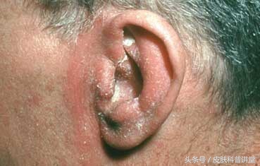 脂溢性皮炎诱因多谁是罪魁祸首,脂溢性皮炎临床指南