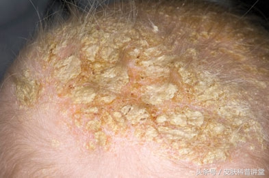 脂溢性皮炎诱因多谁是罪魁祸首,脂溢性皮炎临床指南