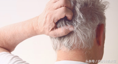 脂溢性皮炎诱因多谁是罪魁祸首,脂溢性皮炎临床指南