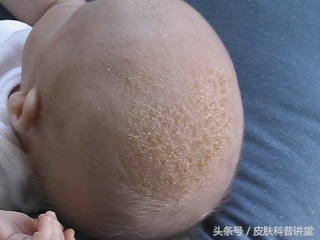 脂溢性皮炎诱因多谁是罪魁祸首,脂溢性皮炎临床指南