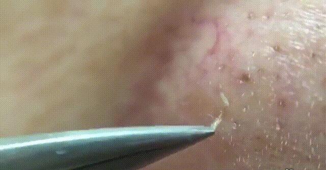 毛孔粗黑头粉刺怎么护肤,毛孔粗大有黑头如何改善真实测评