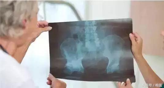 容易误诊成股骨头坏死的疾病,磁共振股骨头坏死有没有可能误诊