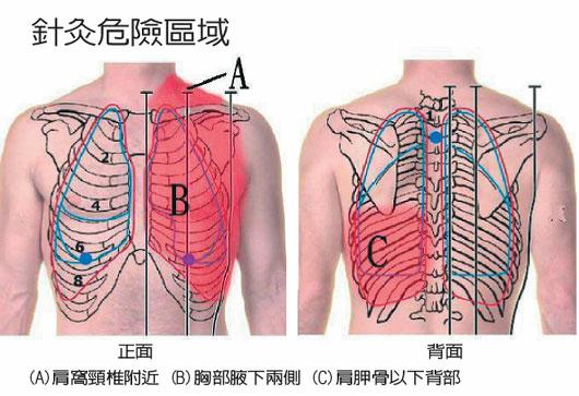 针灸真的没有副作用吗,针灸不对症有什么危害