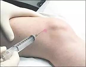 有一种关节肿，叫做滑膜炎